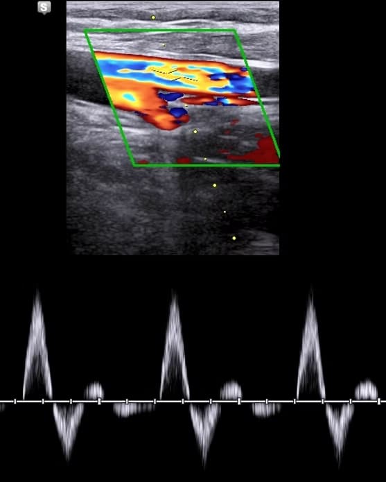 Alt Ekstremite Arteryel Renkli Doppler İnceleme (Bacak Atardamar Ultrasonu) görsel 1
