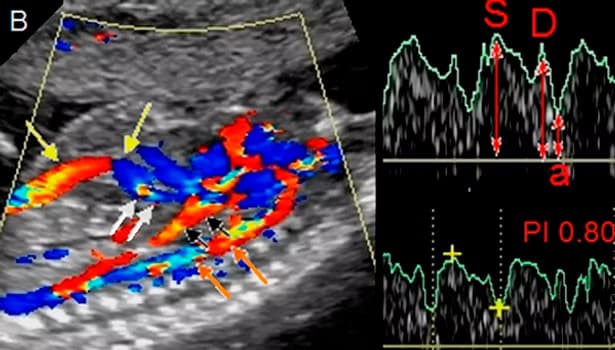 Gebelikte Renkli Doppler Ultrason (Fetal Dolaşım Takibi) görsel 1