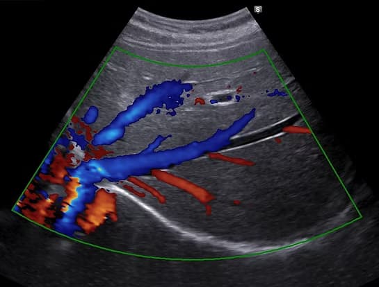 Hepatobiliyer Ultrason (Karaciğer-Safra Kesesi Ultrasonu) görsel 1