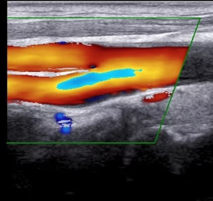 Karotis ve Vertebral Arter Renkli Doppler Ultrasonu görsel 1