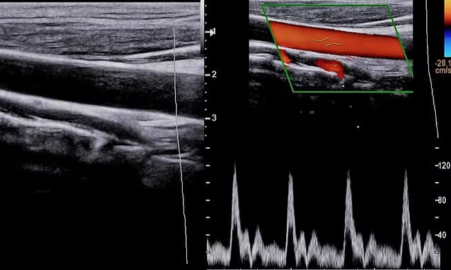 Karotis ve Vertebral Arter Renkli Doppler Ultrasonu görsel 2