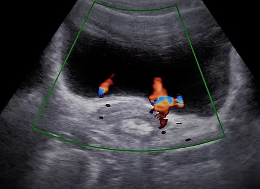 Alt Abdomen Ultrasonu (Pelvik - Alt Karın Ultrasonografisi) görsel 1