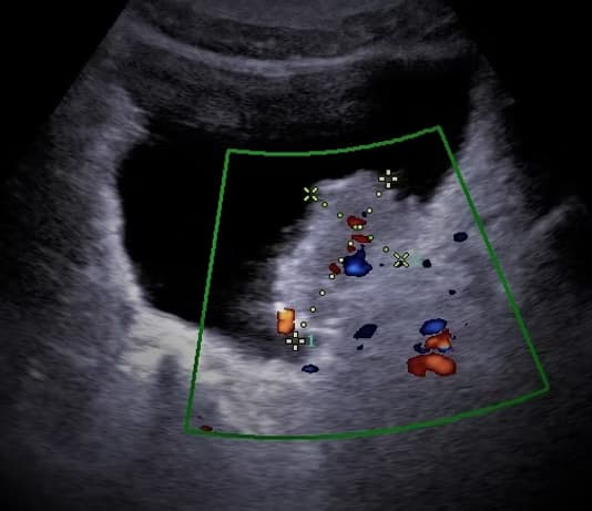 Alt Abdomen Ultrasonu (Pelvik - Alt Karın Ultrasonografisi) görsel 2