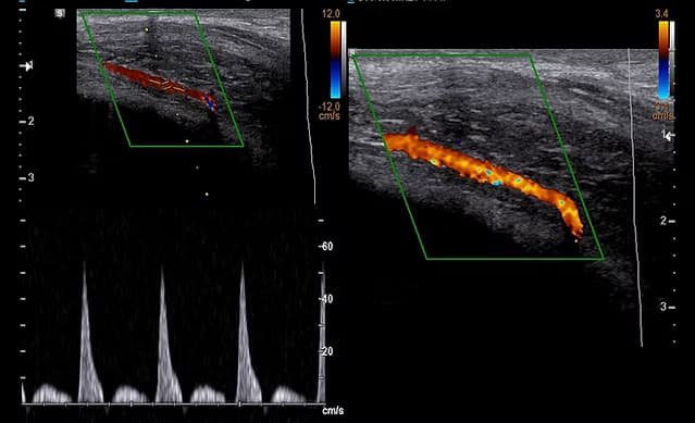 Penil Renkli Doppler Ultrasonu (Sertleşme Sorunu ve Penis Damar Haritalaması) görsel 1