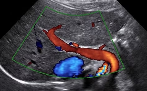 Portal Ven Renkli Doppler Ultrasonu (Karaciğer Dolaşım Doppleri) görsel 1