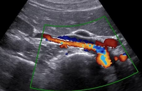 Renal Arter Renkli Doppler Ultrasonu (Böbrek Damar Doppleri) görsel 1