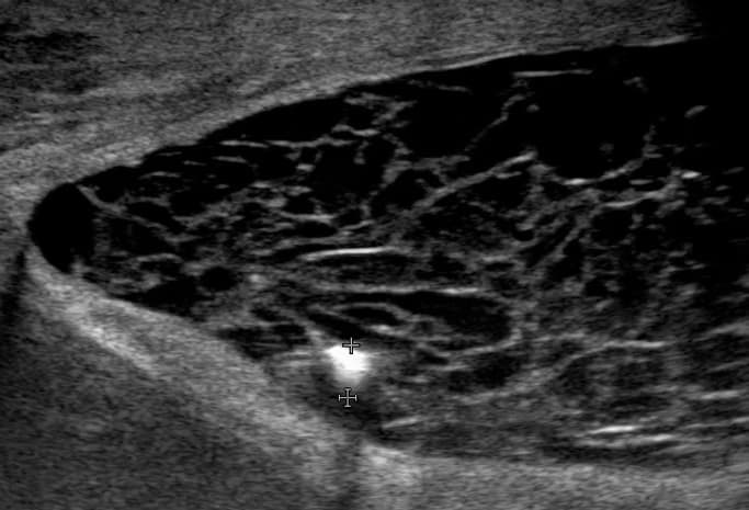 Skrotal Ultrason (Testis Ultrasonografisi ve Renkli Doppler) görsel 1