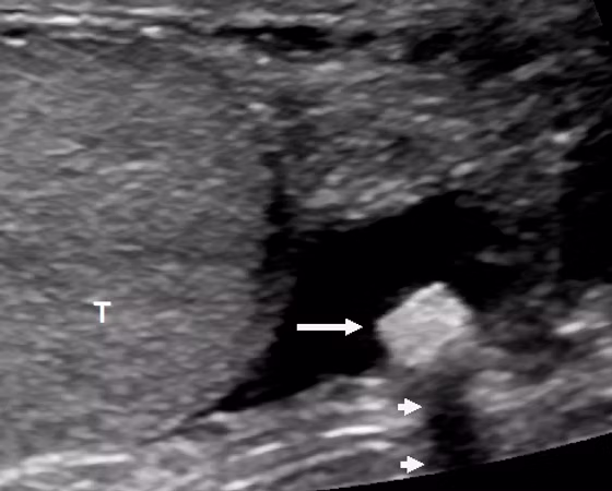 Skrotal Ultrason (Testis Ultrasonografisi ve Renkli Doppler) görsel 2