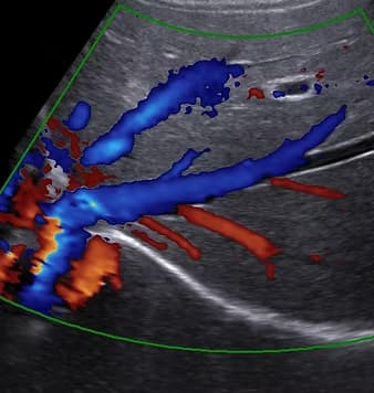 Tüm Abdomen Ultrasonu (Tüm Batın Ultrasonografisi) görsel 1