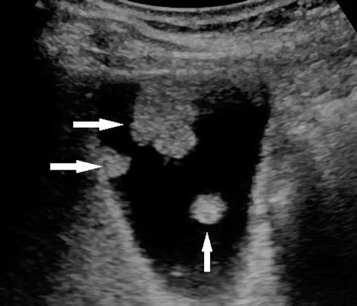 Tüm Abdomen Ultrasonu (Tüm Batın Ultrasonografisi) görsel 2
