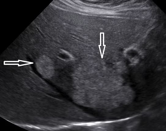 Üst Abdomen Ultrasonu (Üst Karın - Batın Ultrasonografisi) görsel 1