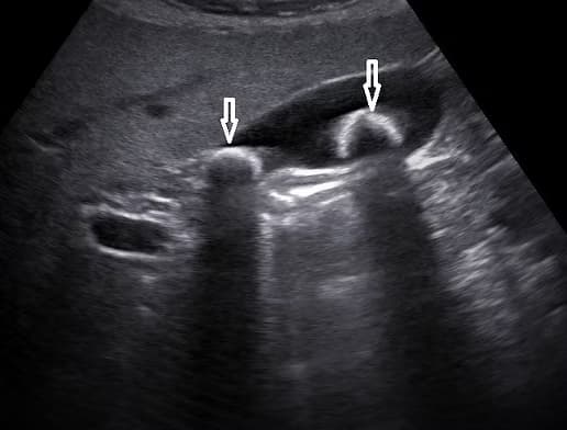 Üst Abdomen Ultrasonu (Üst Karın - Batın Ultrasonografisi) görsel 2